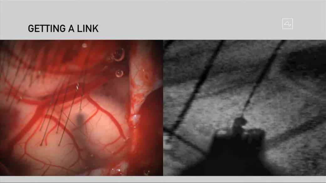   - MONDO / ScreenShot / Neuralink 