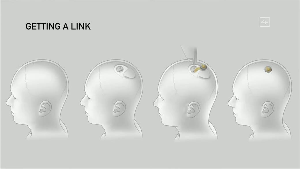 Neuralink čipovanje mozga ljudi 8.jpg - MONDO / ScreenShot / Neuralink   Neuralink čipovanje mozga ljudi 8.jpg - MONDO / ScreenShot / Neuralink