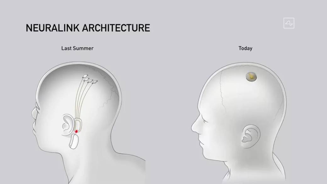 - MONDO / ScreenShot / Neuralink    - MONDO / ScreenShot / Neuralink