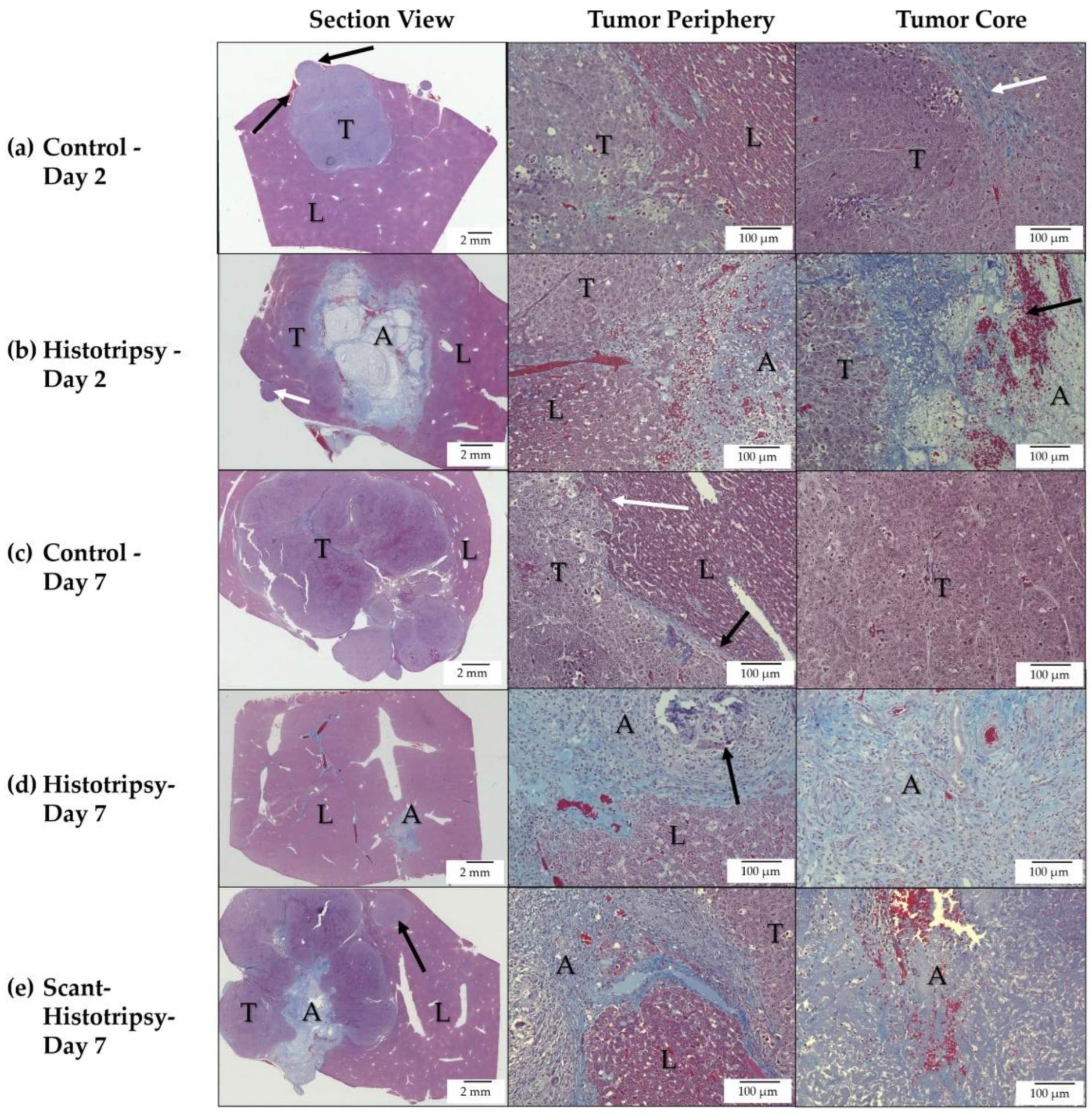  Histotripsija lečenje - Univerzitet Mičigen 